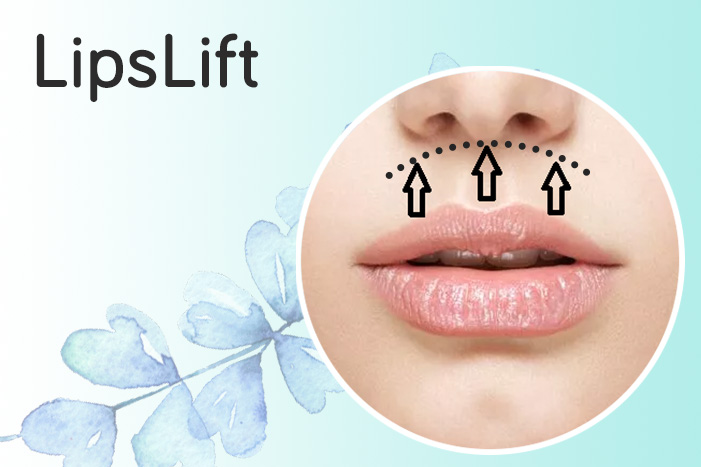 LipsLift